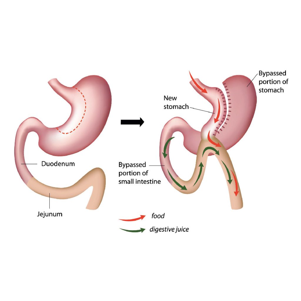 gastric-by-pass-better-me